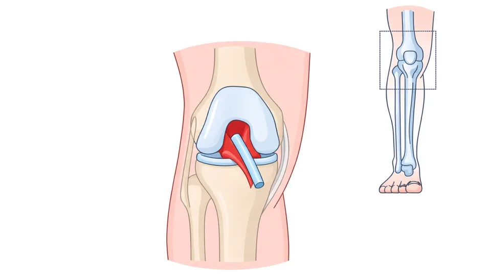 Diagram of ACL reconstruction of the knee